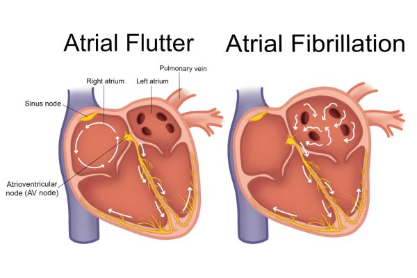Unlocking Heart Health: A Comprehensive Guide to Atrial Fibrillation Treatment for Seniors